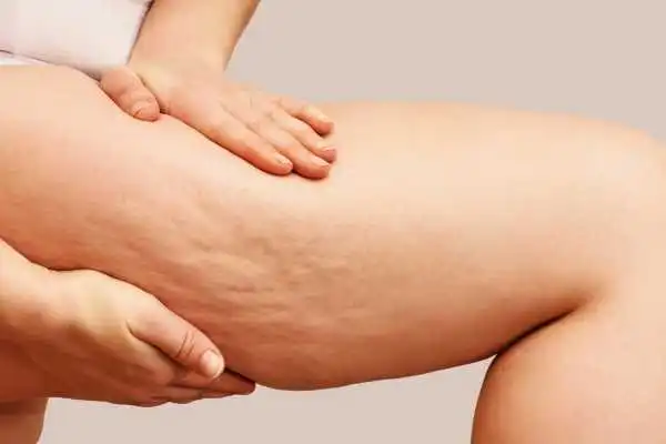 Image of woman showing leg with cellulite Mickleover