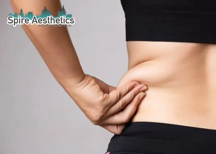 Image of woman pinching fat on their hips Mickleover. Fat Freezing treatment
