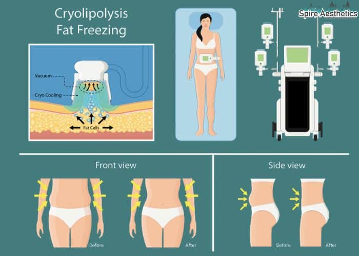 Image of diet and fat freezing combined for best results for Spire Aesthetics Mickleover