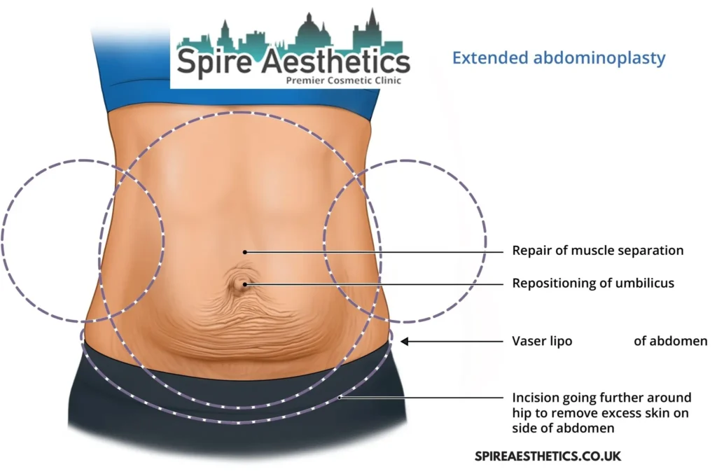 Understanding Loose Skin After Gastric Band Mickleover Surgery and HIFU Treatment