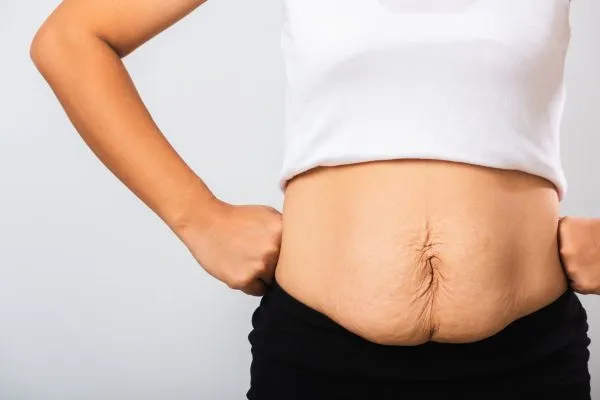 Image of a woman's stomach after weight loss with sagging skin following a gastric band Mickleover