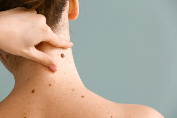 skin blemish removal Mickleover treatment