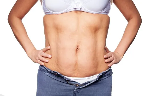 sagging skin on woman's stomach after weight loss injections Mickleover