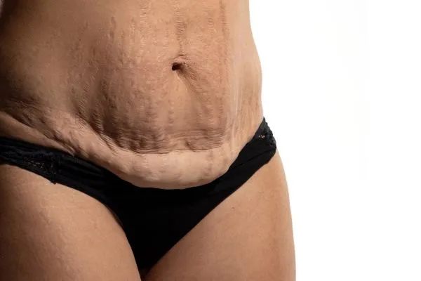 Image of womans stomach after weight loss injections Mickleover showing saggy skin