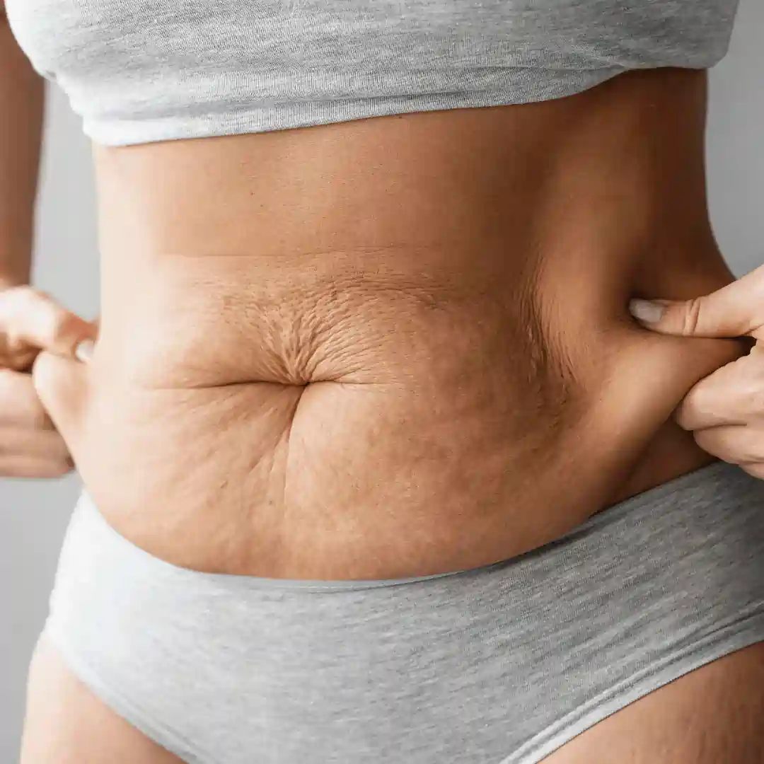 Is It Normal to Have Loose Skin After Pregnancy Mickleover?